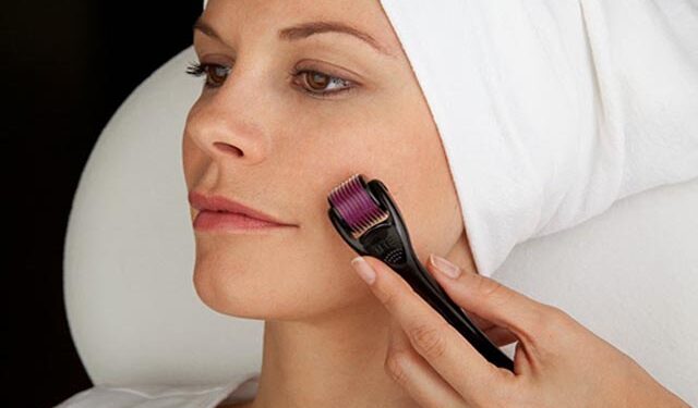 Μεσοθεραπεία προσώπου με MicroNeedling στο Ινστιτούτο Αισθητικής Charm