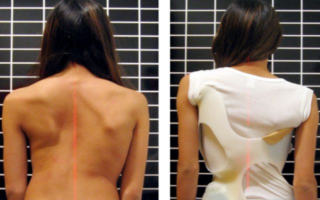 scoliosis11