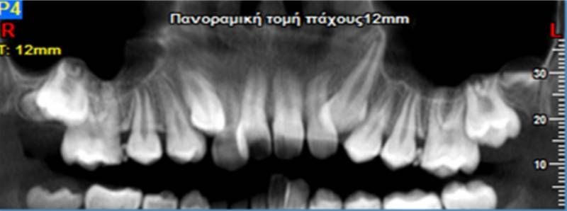 Πανοραμική δοντιών: όλα όσα θέλεις να γνωρίζεις