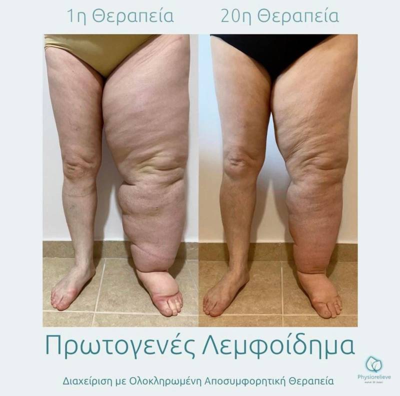 6 Μαρτίου, Η Παγκόσμια Ημέρα του Λεμφοιδήματος