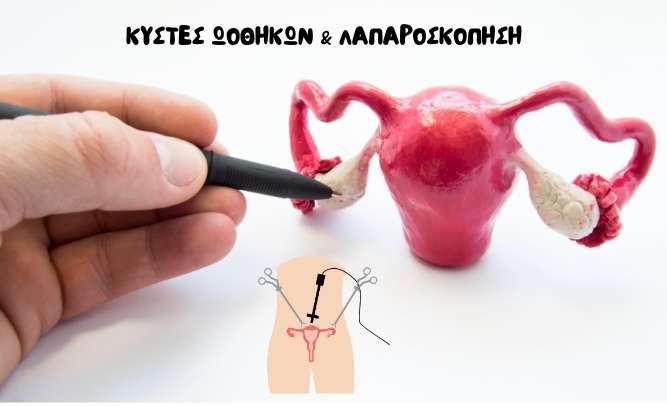 Τα πλεονεκτήματα της Λαπαροσκόπησης στην Διάγνωση & Θεραπεία των Κύστεων στις Ωοθήκες