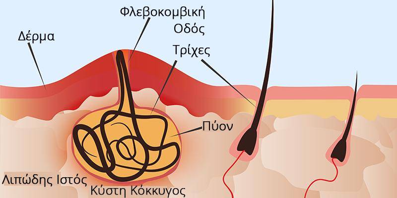 Κύστη κόκκυγος: Όλα όσα πρέπει να γνωρίζετε